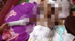 Aldelia Akhirnya Meninggal setelah Dibakar Teman Sendiri di Sekolah