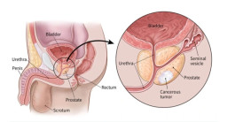 Masalah Prostat, Momok bagi Pria Usia 50 Tahun ke Atas