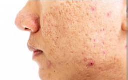 Serum Saja Tak Cukup untuk Menghilangkan Kulit Bopeng