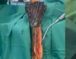 Pengendara Motor Tertusuk Kayu hingga Tembus ke Belakang