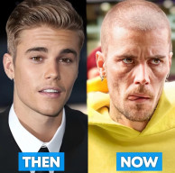 Kondisi Justin Bieber makin Mengkhawatirkan