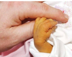 Bayi Menguning, Pasutri di Kota Madiun Protes ke Rumah Sakit