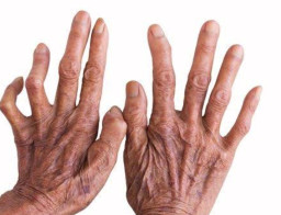 Penyakit Kusta Melanda Sampang