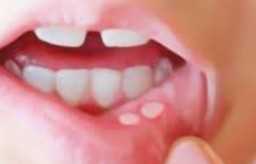 Jangan Remehkan Sariawan, Bisa Jadi Gejala Penyakit Ganas di Mulut