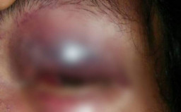 Remaja Terbelakang Mental, Diduga Disiksa Kakak Kandung hingga Mata Memar