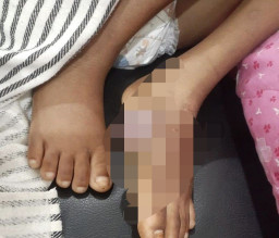 Miris, Diduga Bocah Penderita Kanker di Lampung Selatan Terkendala KIS