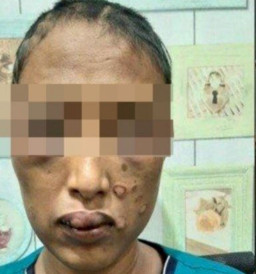 Dituduh Selingkuh, RN Disundut Rokok Suami dan Kemaluannya Dimasuki Cobek