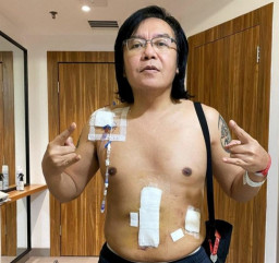 Idap Kanker Langka, Begini Kondisi Ari Lasso