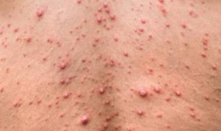 Mereka yang Lahir Tahun 1980 ke Bawah, Lebih Terproteksi dari Cacar Monyet