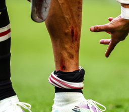 Kaki Ronaldo sampai Berdarah, MU Tetap Saja Kalah