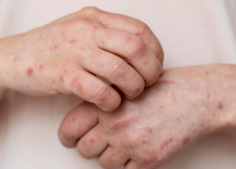 Setelah Covid 19, Ramalan Bill Gates Soal Cacar Monyet Jadi Kenyataan lagi