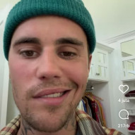 Wajah Justin Bieber Lumpuh Separo, Begini Penampakannya