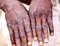 IDI Minta Semua Dokter Waspadai Gejala Cacar Monyet pada Pasien