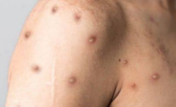 IDI Ingatkan Bahayanya Cacar Monyet