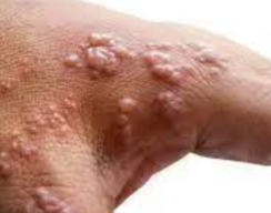 Jika Kena Cacar Monyet, Jangan Menggaruk Kulit!