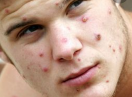 Gejala Cacar Monyet, Muncul Ruam di Dekat Alat Kelamin