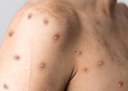 Homoseksual Diprioritaskan Divaksin Cacar Monyet