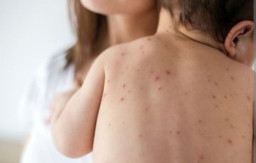 Campak Mengganas, Kasusnya Naik 32 Kali Lipat di Indonesia