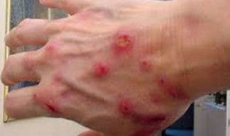 Kupas Mitos dan Fakta di Balik Kusta