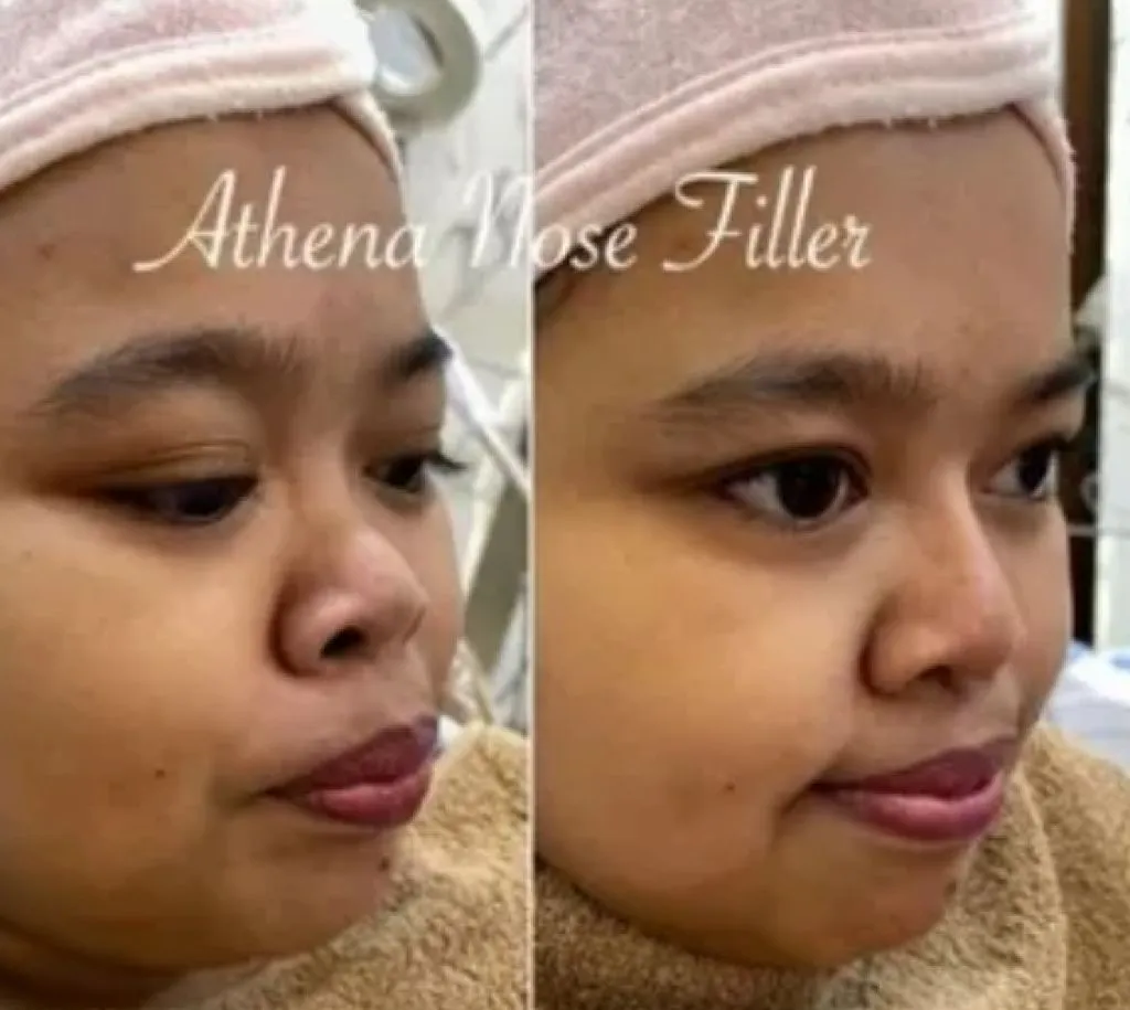 Difilller, Hidung Kekeyi Berubah