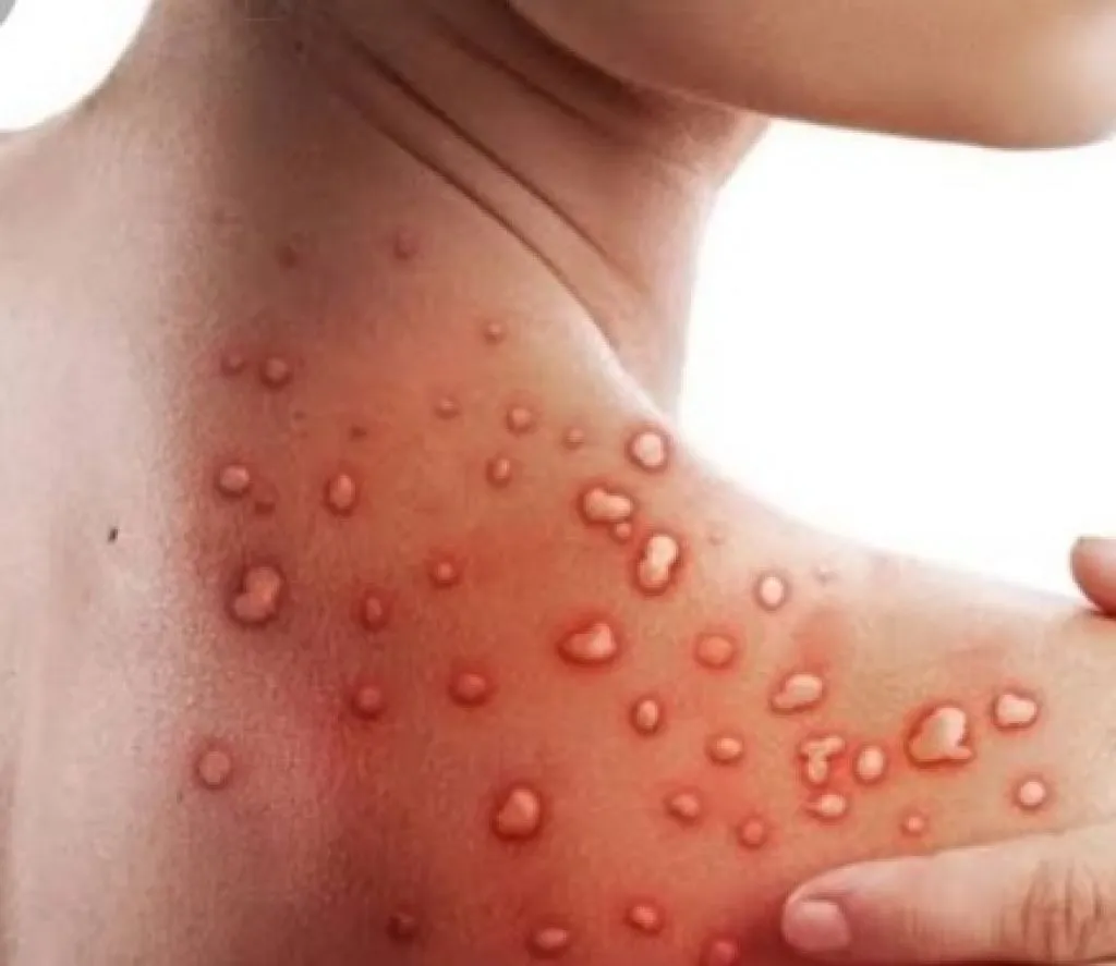 Pasien HIV Meninggal karena Cacar Monyet
