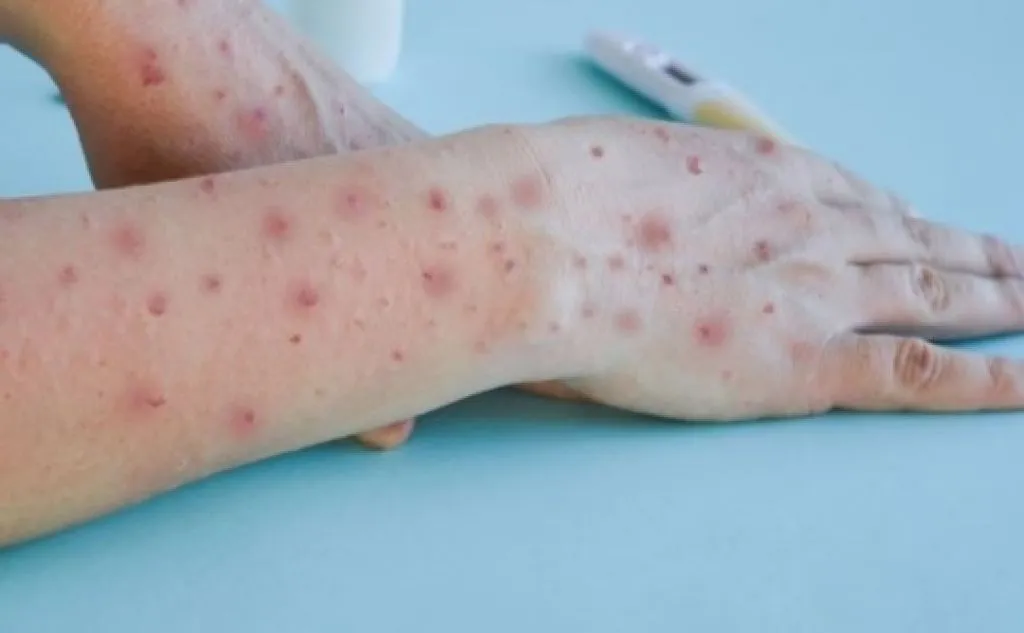 Selain Ruam di Kulit, Cacar Monyet Bergejala Seperti Flu Biasa