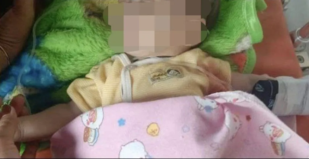 Diserang Monyet, Usus dan Hati Bayi Usia 1 Tahun Keluar