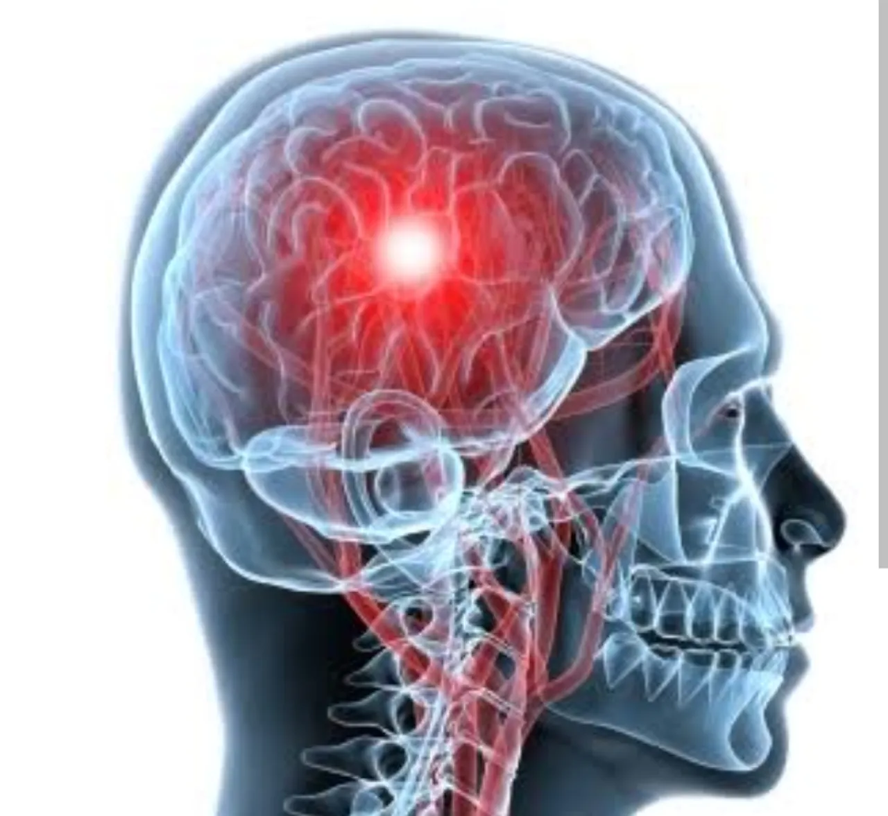 Golongan Darah A Lebih Berisiko Stroke