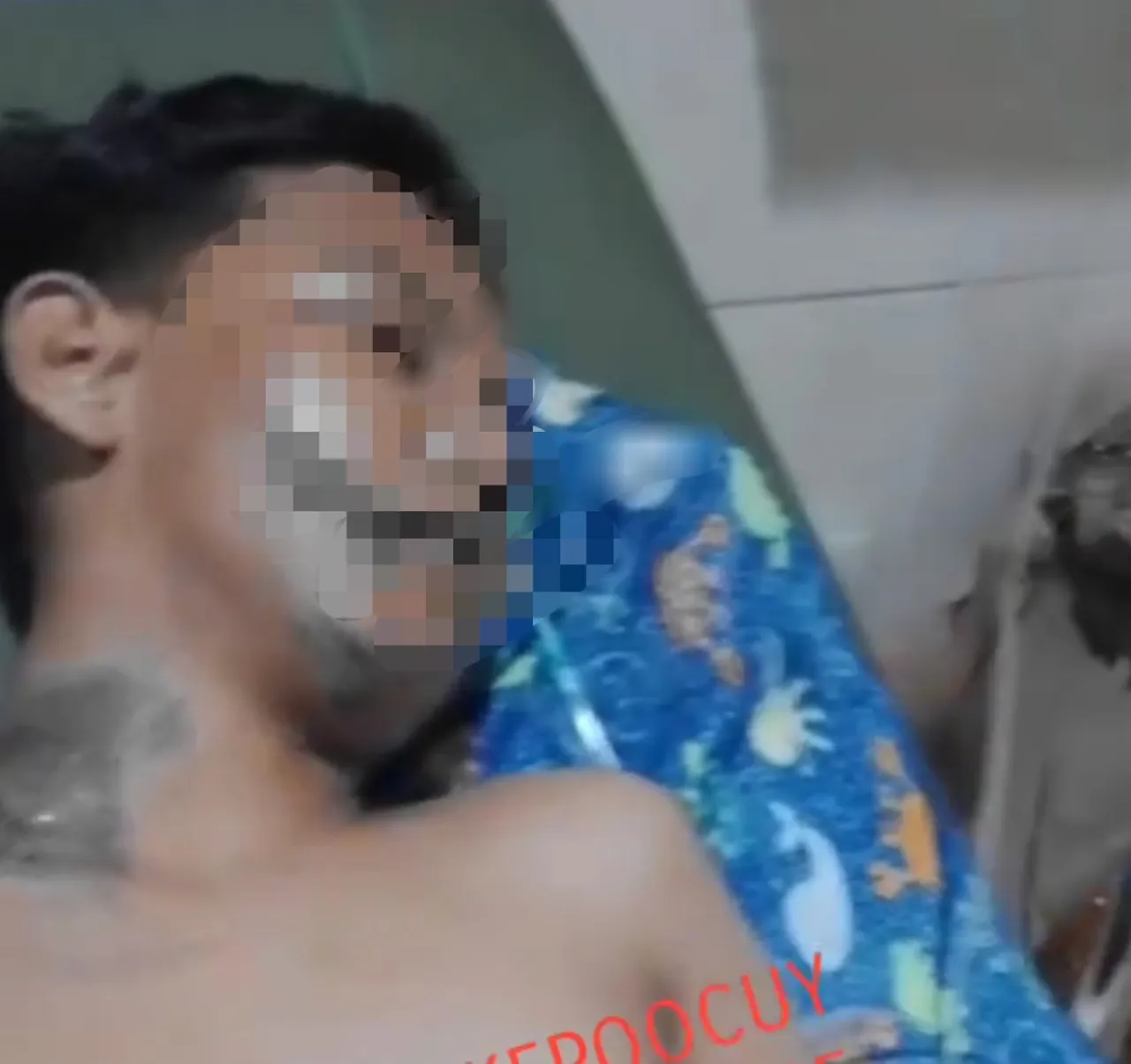 Dibegal, F Harus Kehilangan Kaki Kiri