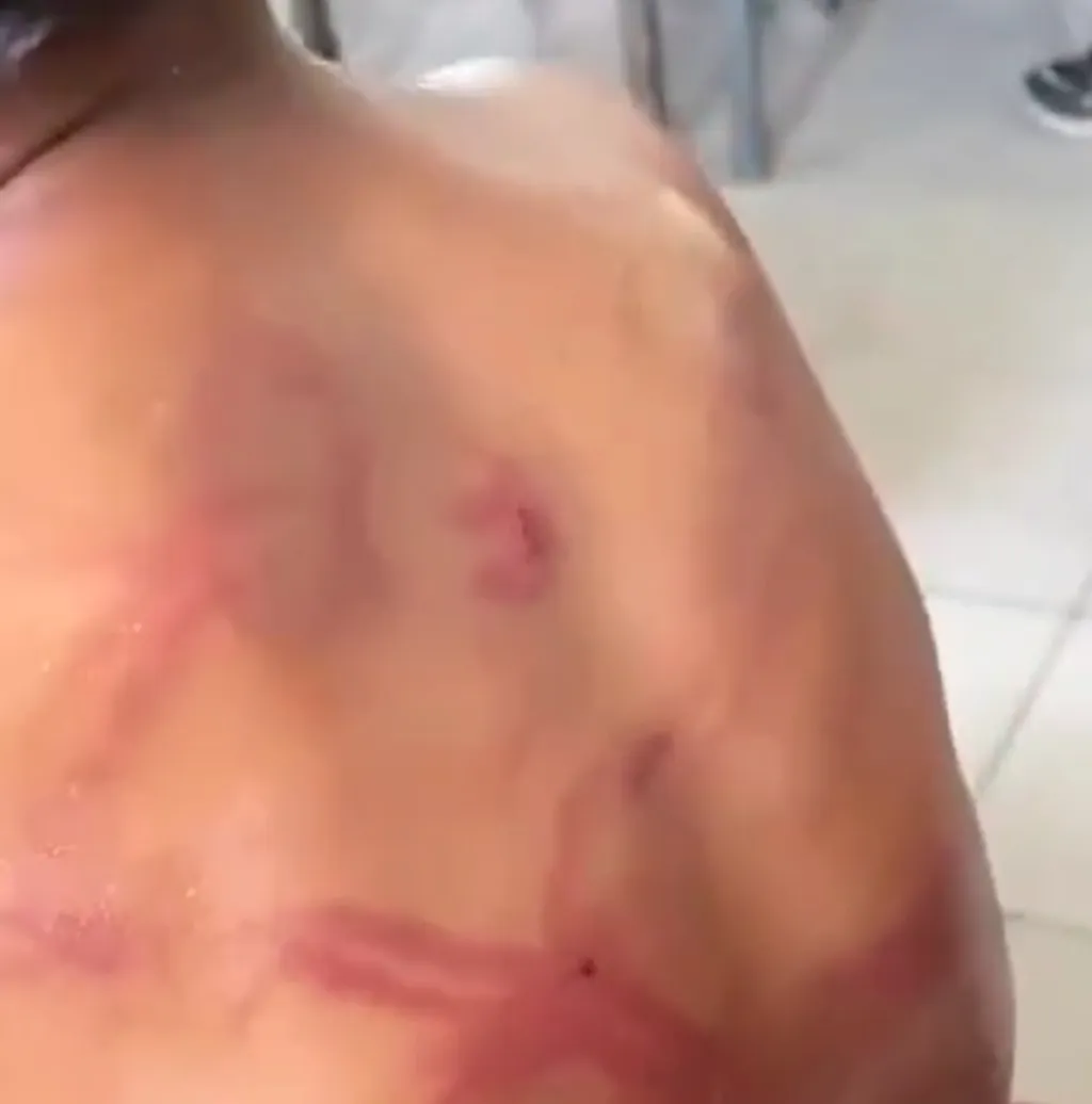 Video Tubuh Anak dengan Punggung penuh Luka