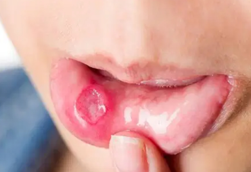 Salah Satu Gejala Kanker Mulut Adalah Sariawan