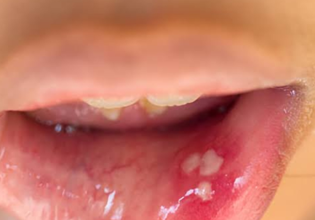 Berkumur Air Garam Bisa Sembuhkan Sariawan